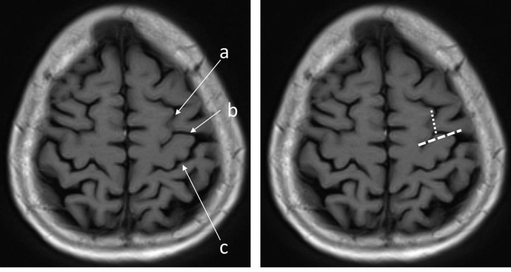 central-sulcus-radiology-cases