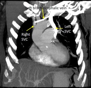 Persistent Left Svc – Radiology Cases