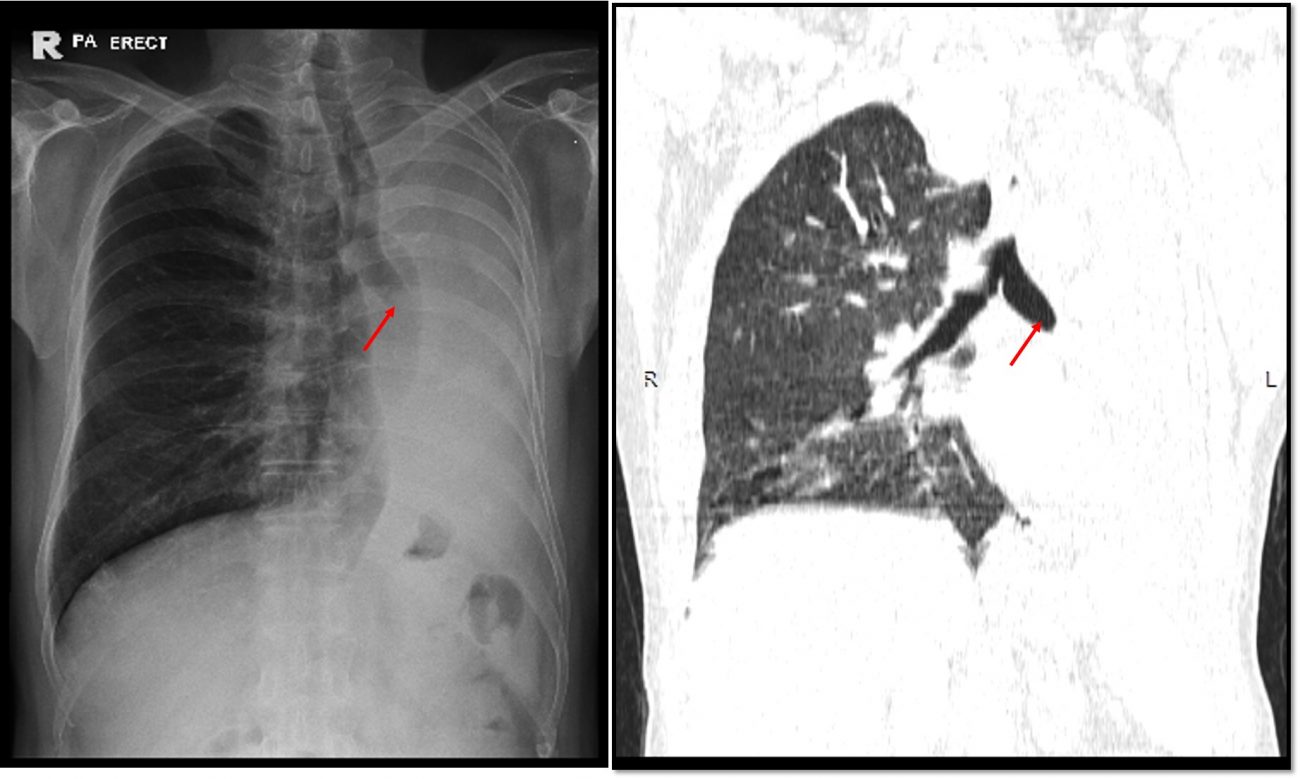 Radiology Cases Page 35 Compilation Of Cases Emphasize On Imaging