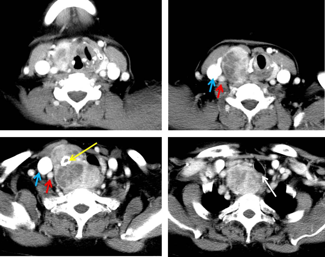 Papillary Thyroid Carcinoma Radiology Cases 