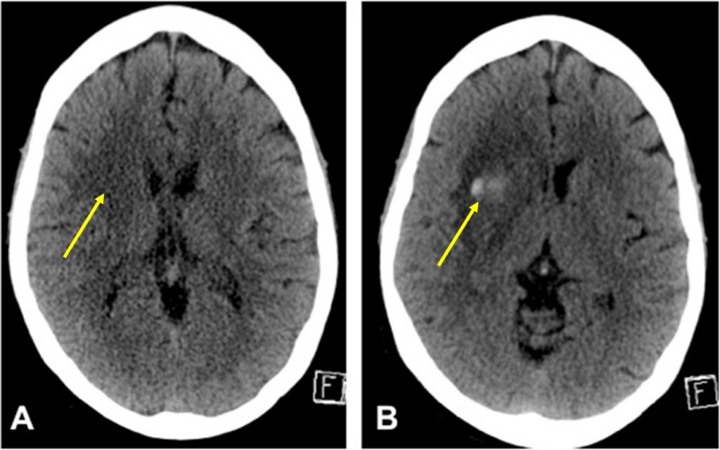 hemorrhagic-transformation-of-cerebral-infarct-radiology-cases