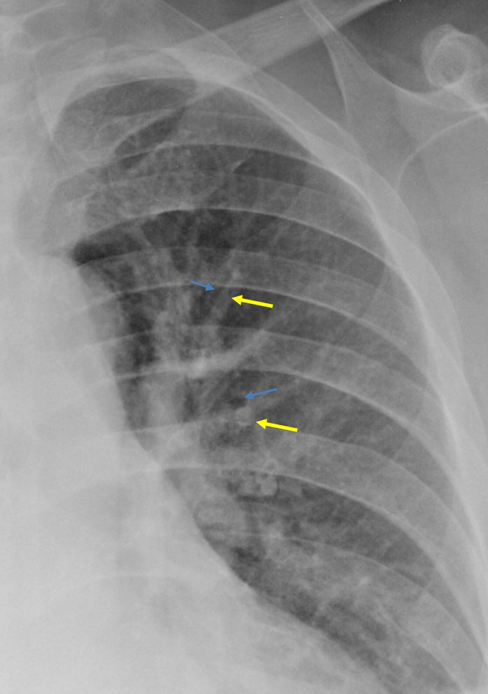 Upper Lobe Diversion Radiology Cases