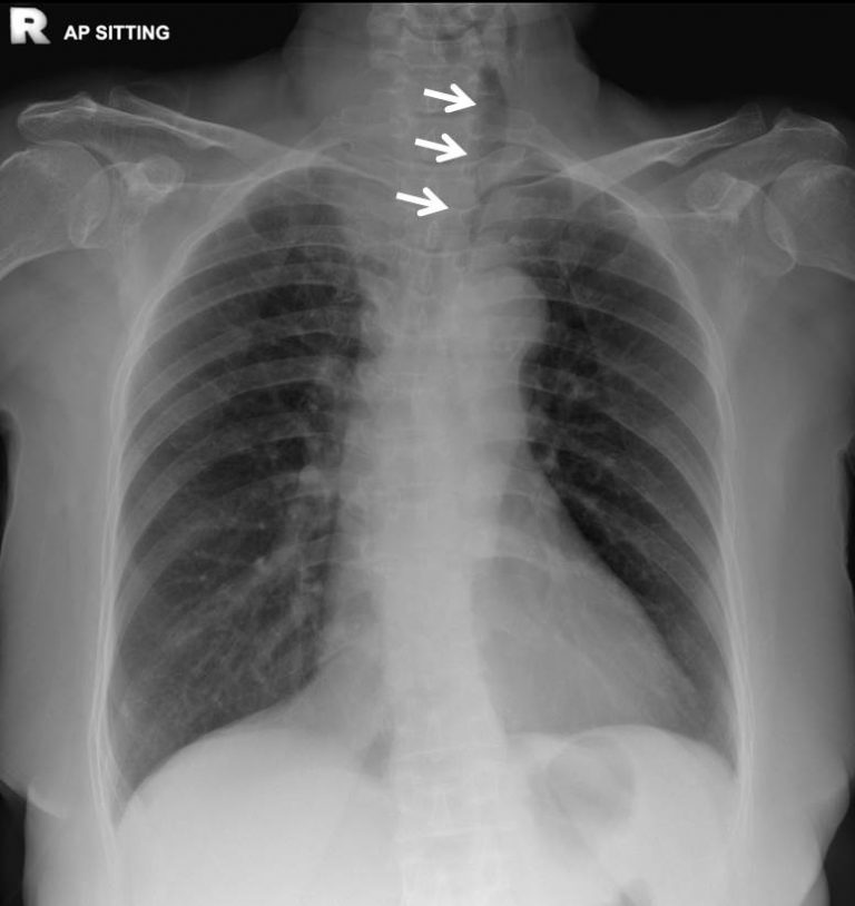 Papillary Thyroid Carcinoma Radiology Cases