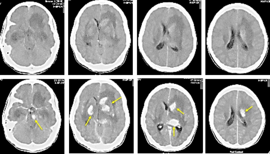 Tuberculous encephalopathy Radiology Cases