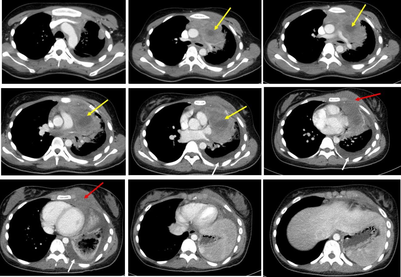 Mediastinal Mass Radiology Cases