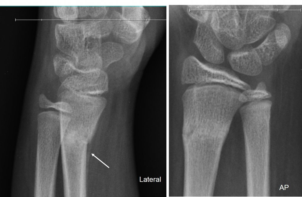 Torus fracture – Radiology Cases