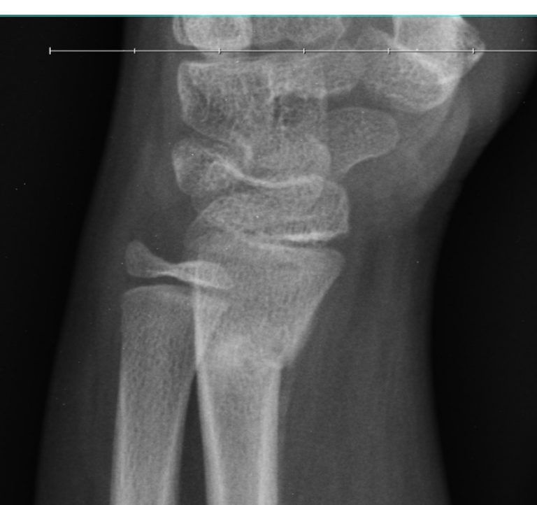 Torus fracture – Radiology Cases