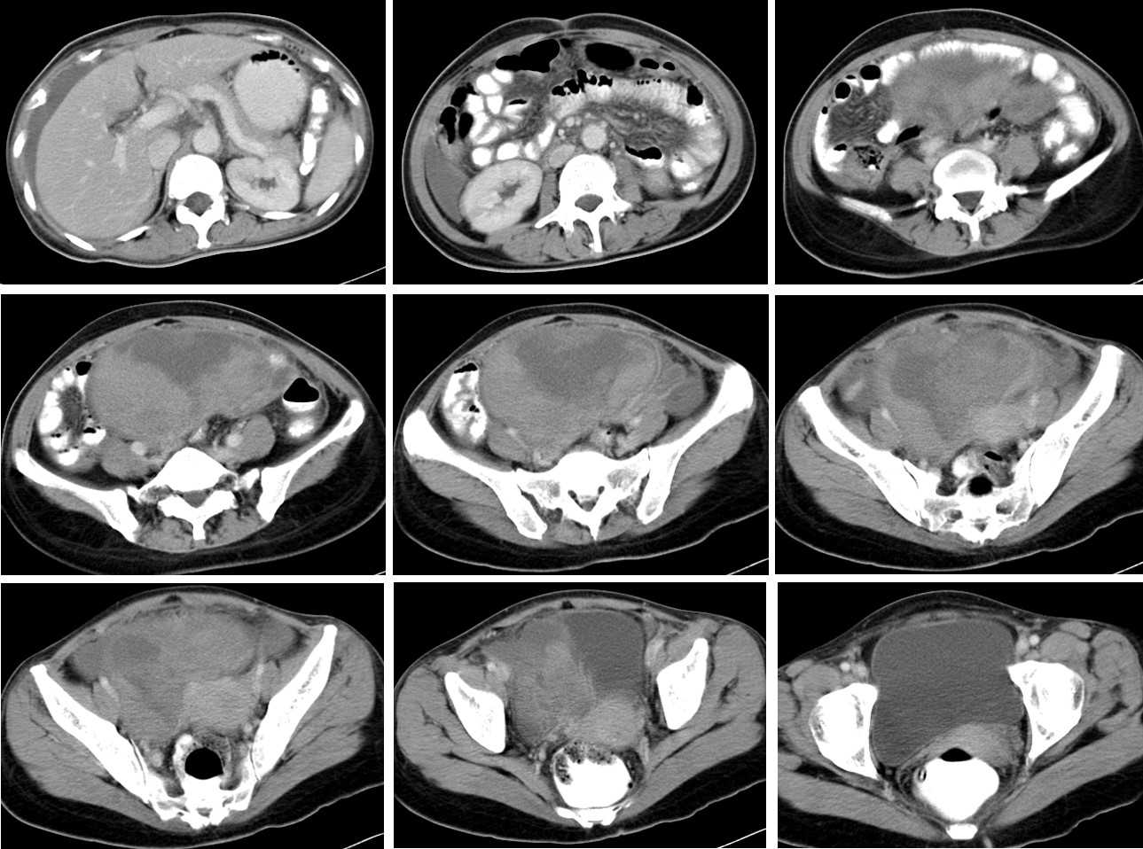 Clear Cell Carcinoma Of Both Ovaries Radiology Cases 2209