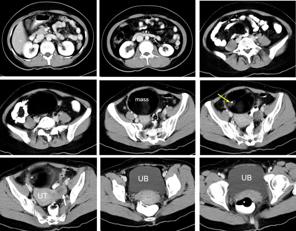 benign-cystic-ovarian-teratoma-radiology-cases