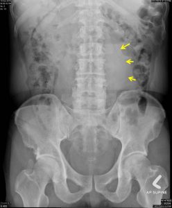 abdominal aortic aneurysm xray