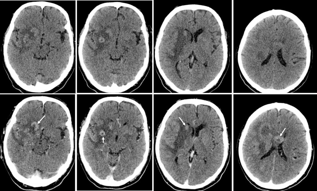 primary-cns-lymphoma-radiology-cases