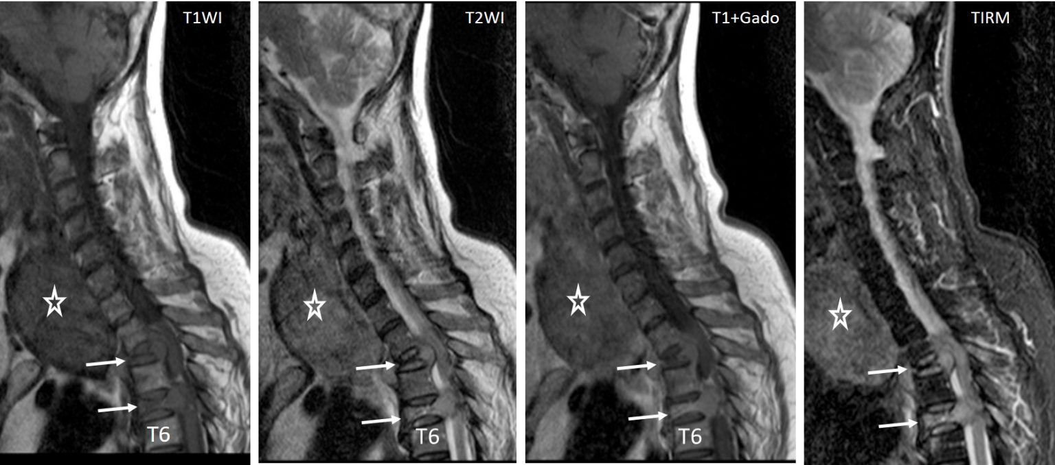 Metastatic compression fracture Radiology Cases