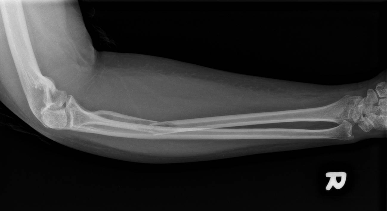 pathological fracture neck of femur radiology