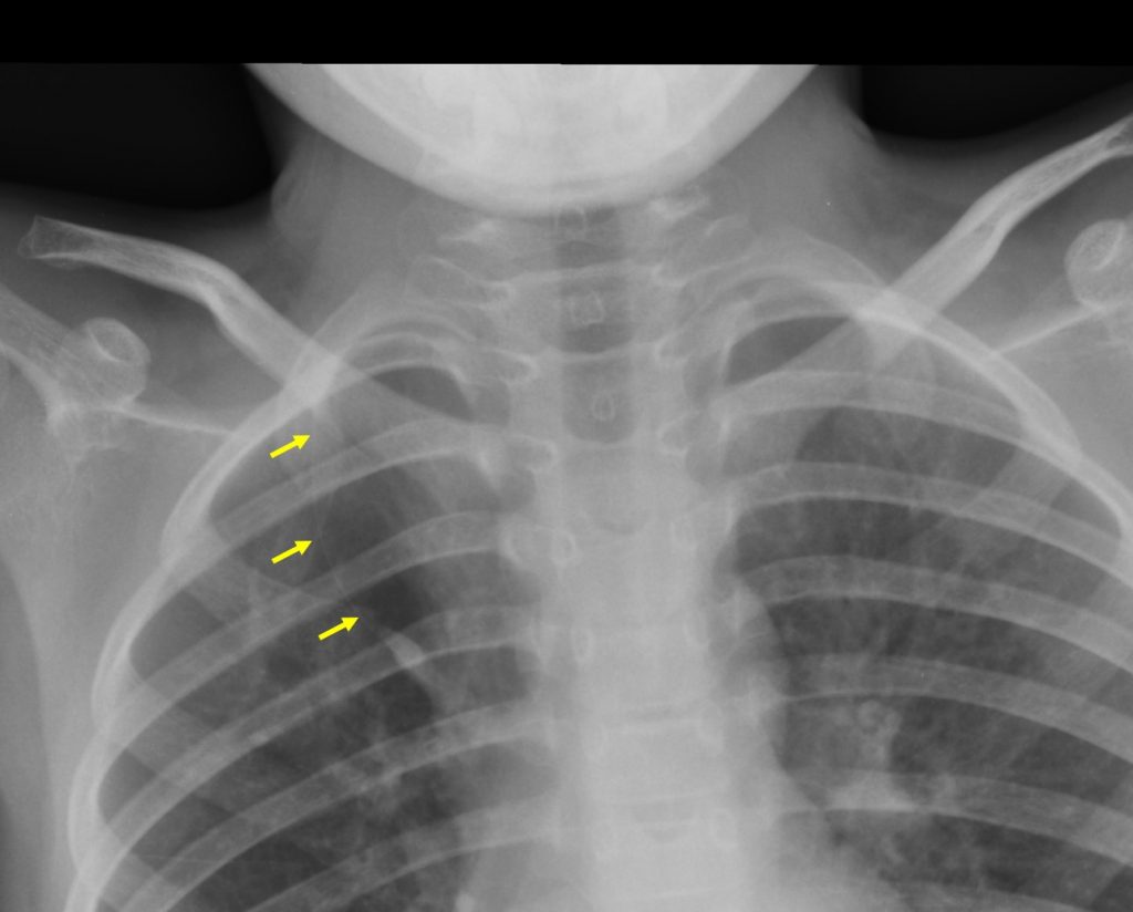 Azygos fissure Radiology Cases