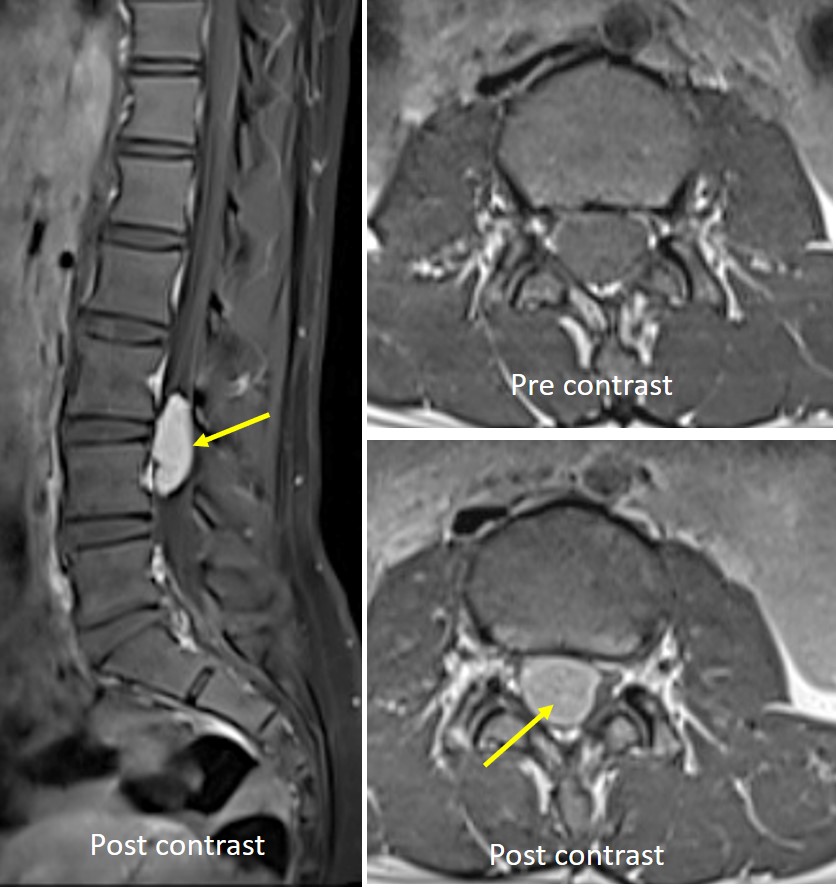 Two Spinal Lesions Schwannoma And Meningioma Radiology Cases