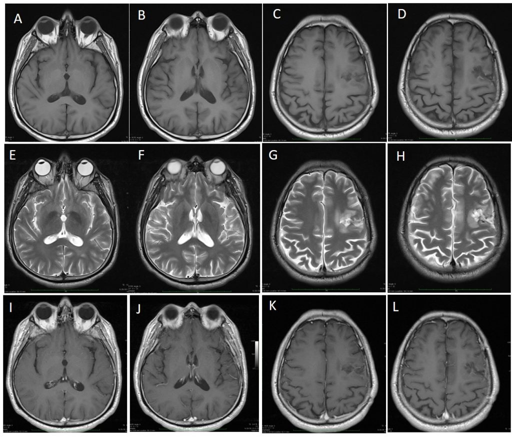 primary-cns-lymphoma-with-recurrence-radiology-cases