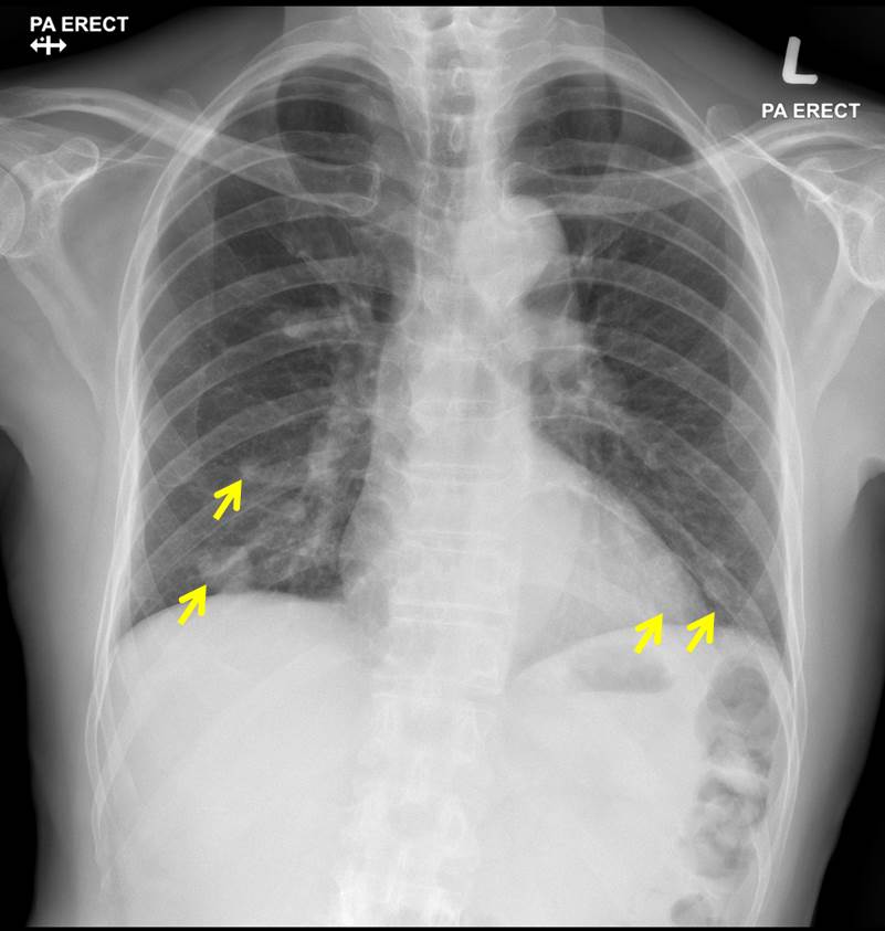 Hyperdense Cerebral Metastasis – Radiology Cases