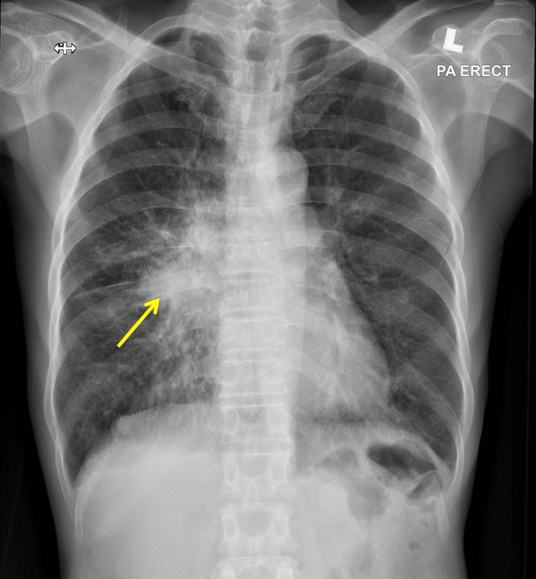 Lung Adenocarcinoma With Cerebral Metastasis – Radiology Cases