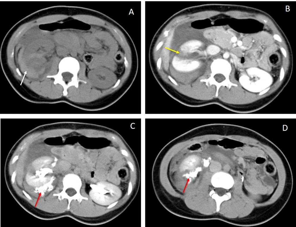 Grade Iv Renal Injury Radiology Cases