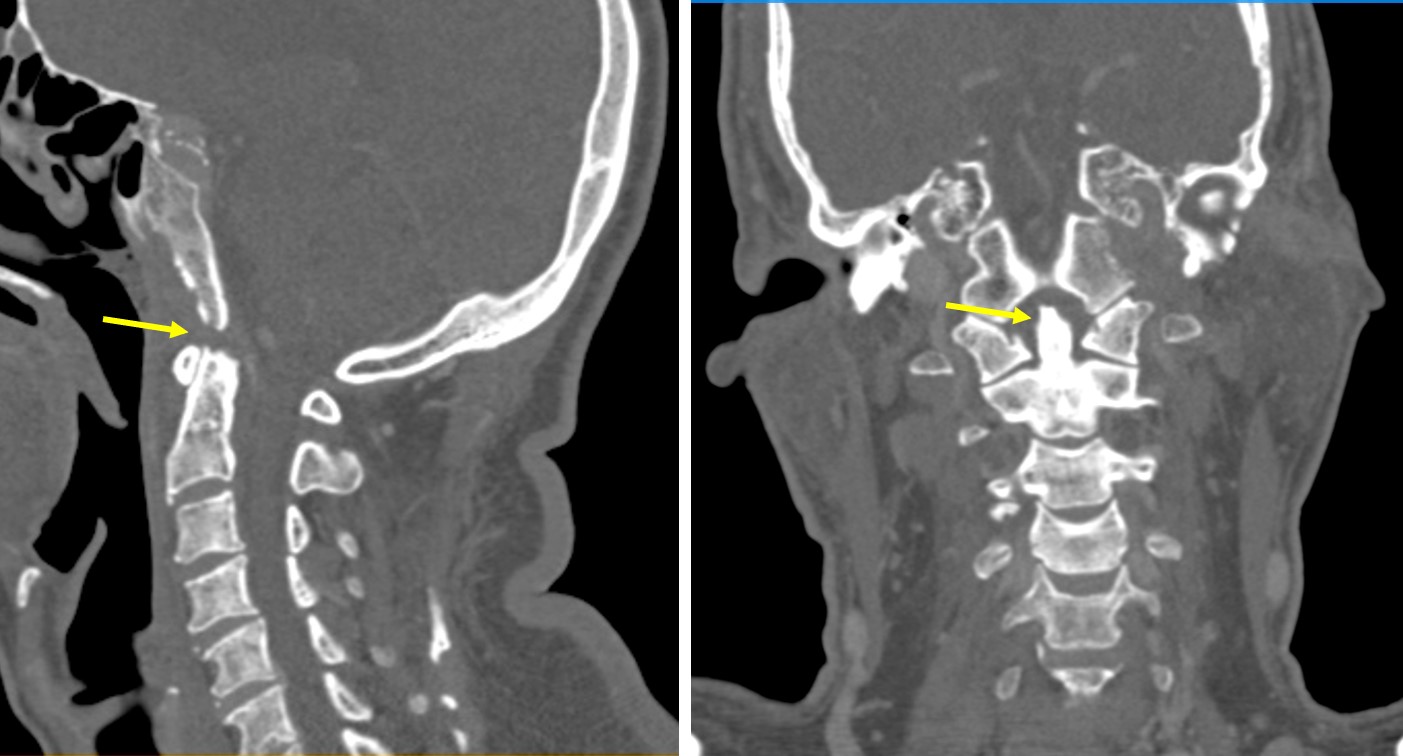 Cervical vertebrae osteomyelitis Radiology Cases