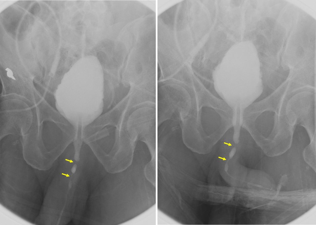 anterior-urethral-strictures-radiology-cases