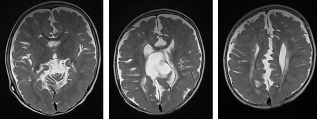 Partial Agenesis Of Corpus Callosum Radiology Cases