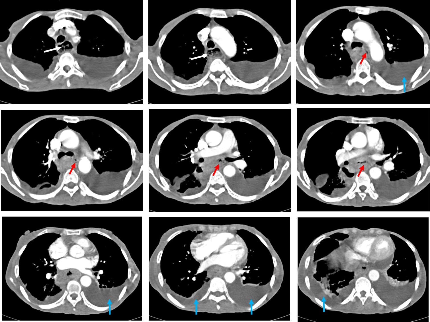 Esophageal Carcinoma Radiology Cases