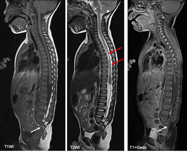 sacral agenesis anatomy