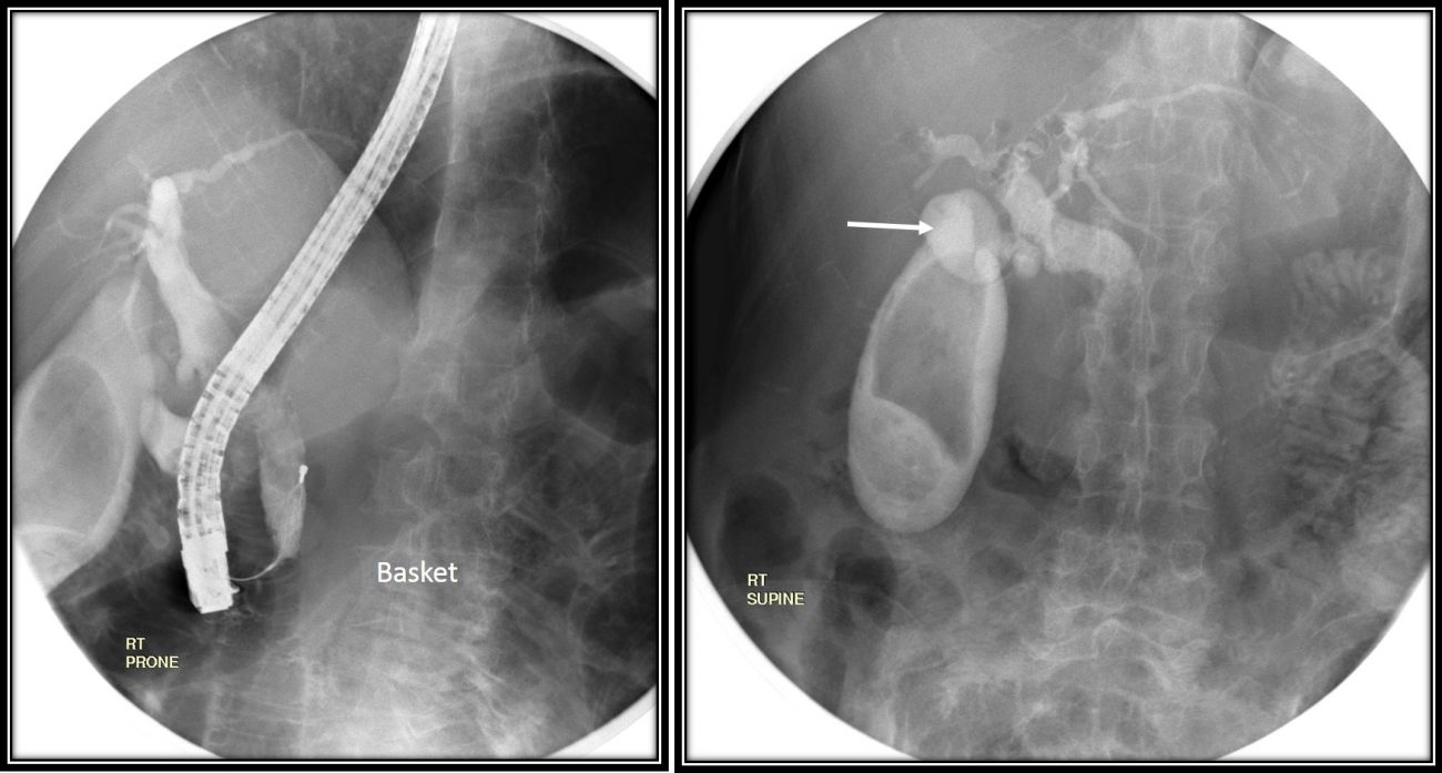 Endoscopic removal of choledocholithiasis Radiology Cases