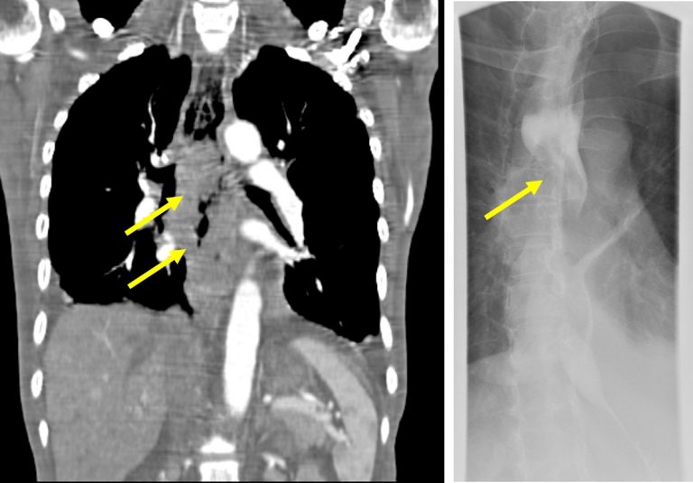 Esophageal carcinoma Radiology Cases