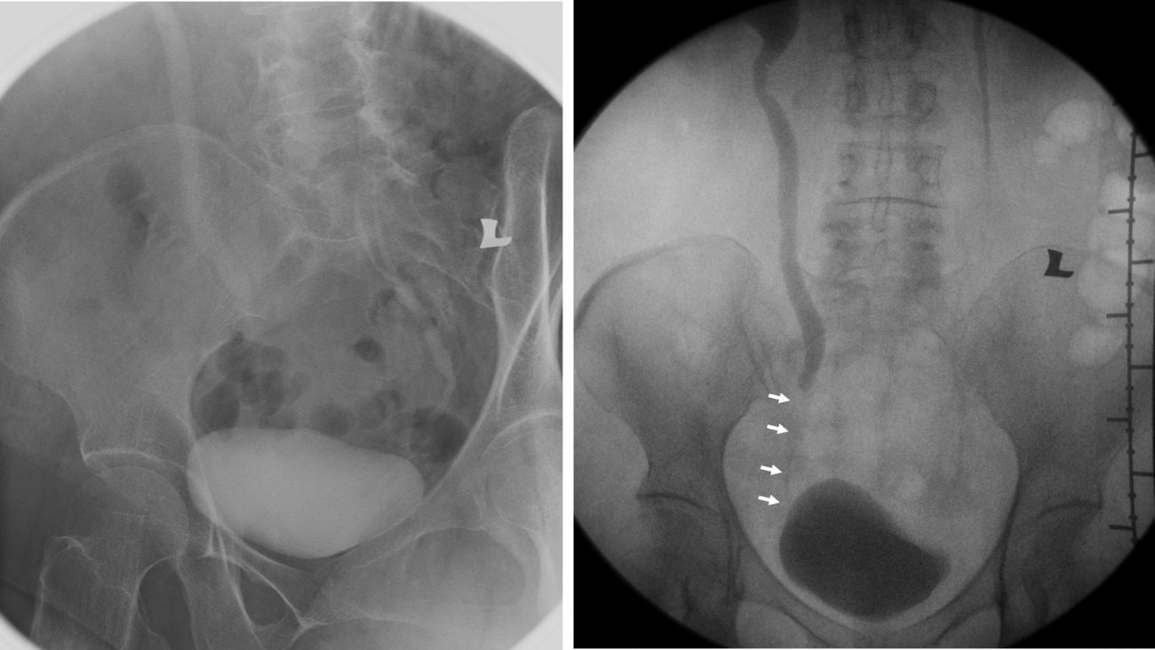 Adult ureteral stricture and duplex system of contralateral side