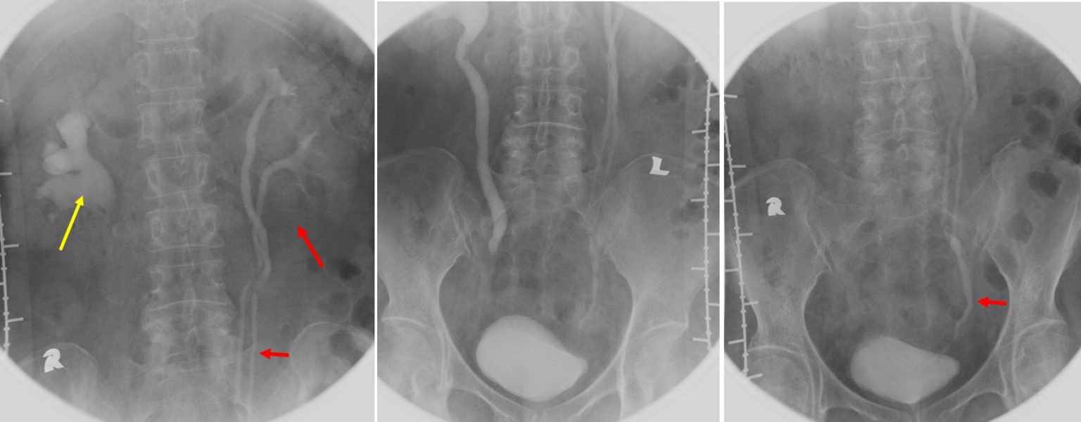 Adult ureteral stricture and duplex system of contralateral side