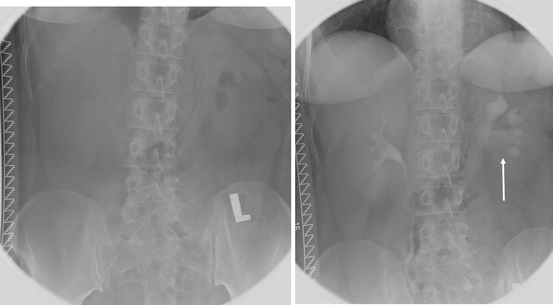 pelviureteric-junction-obstruction-radiology-cases