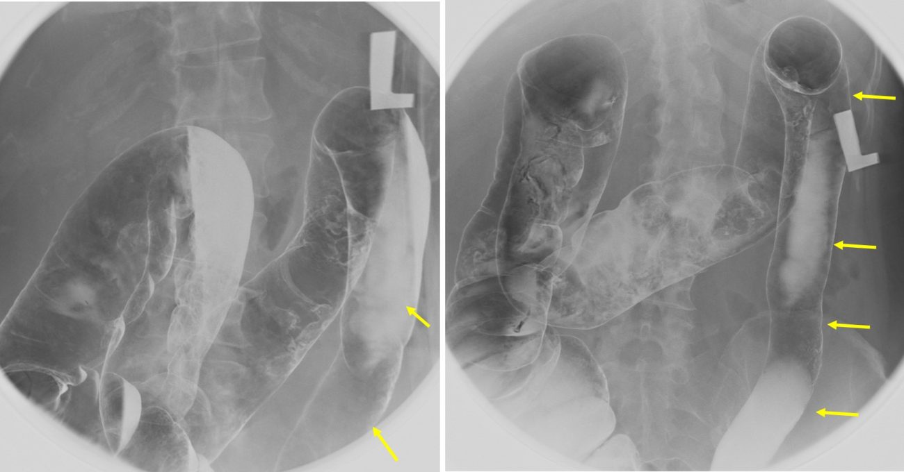 ‘Lead pipe’ colon sign Radiology Cases