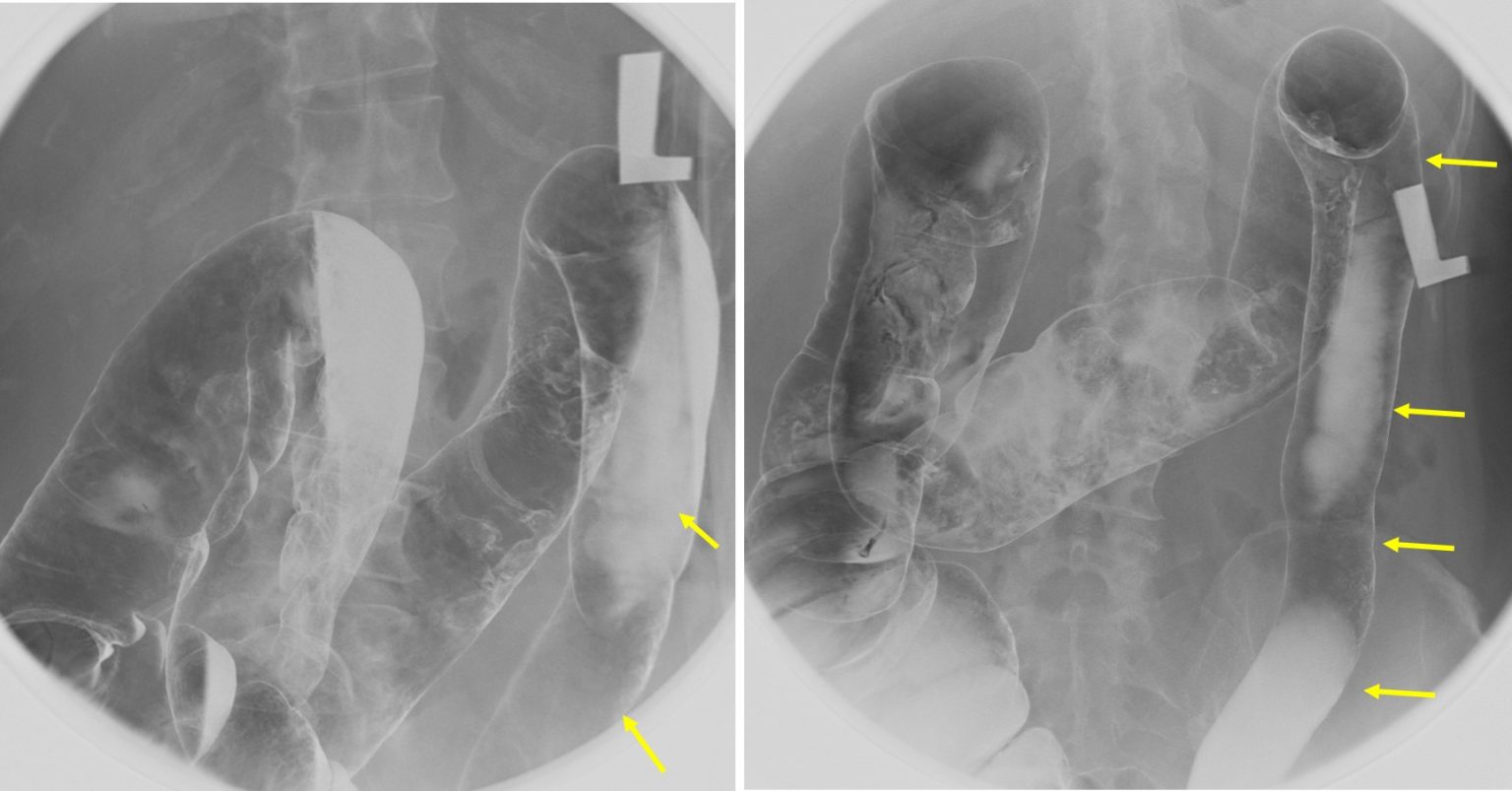 ‘Lead pipe’ colon sign Radiology Cases