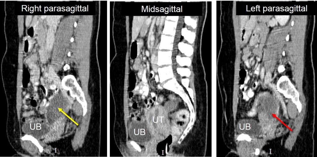 Bilateral endometriotic cysts. Radiology Cases