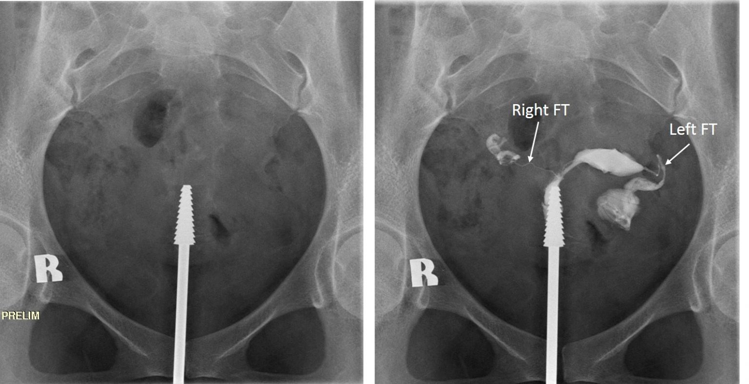 Hydrosalpinx Radiology Cases