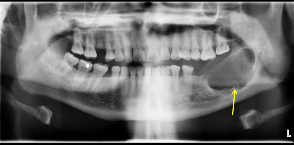 Ameloblastoma Radiology Cases