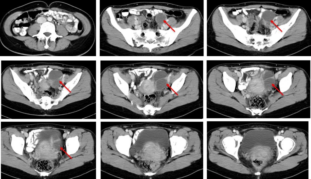 endometriotic-cyst-radiology-cases