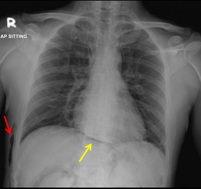 Continuous diaphragm sign Radiology Cases