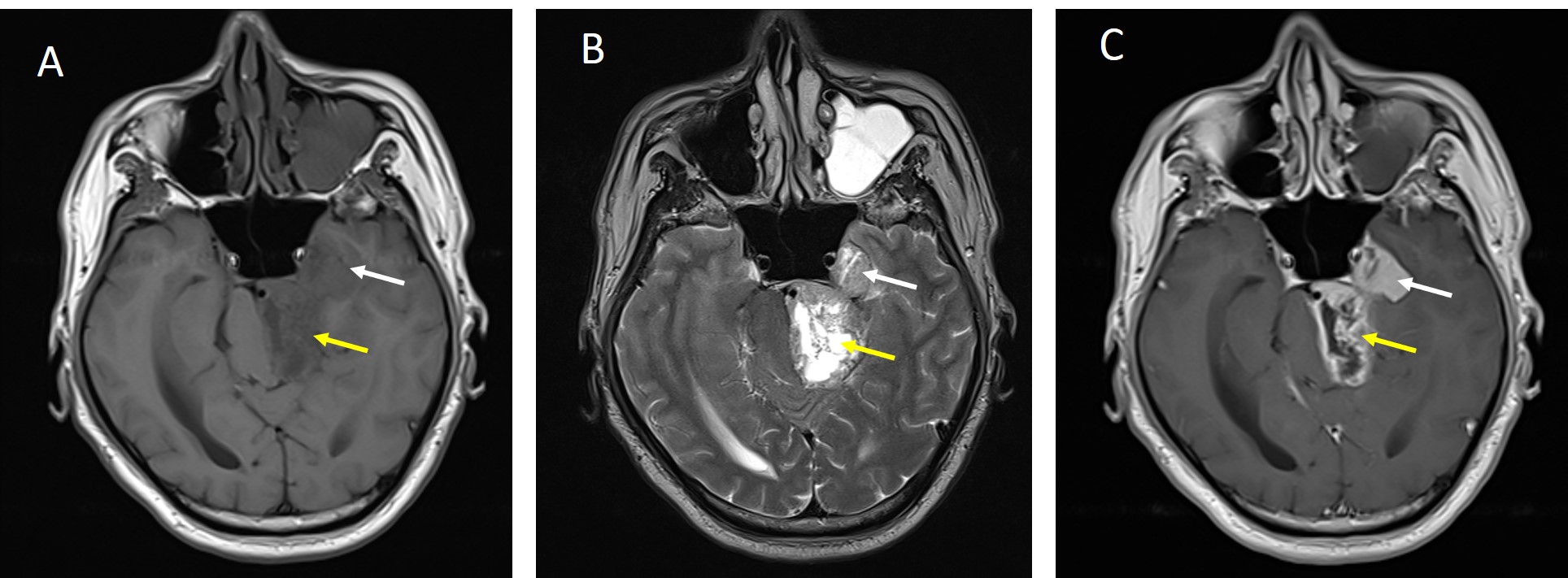 Intracranial Trigeminal Schwannoma Radiology Cases