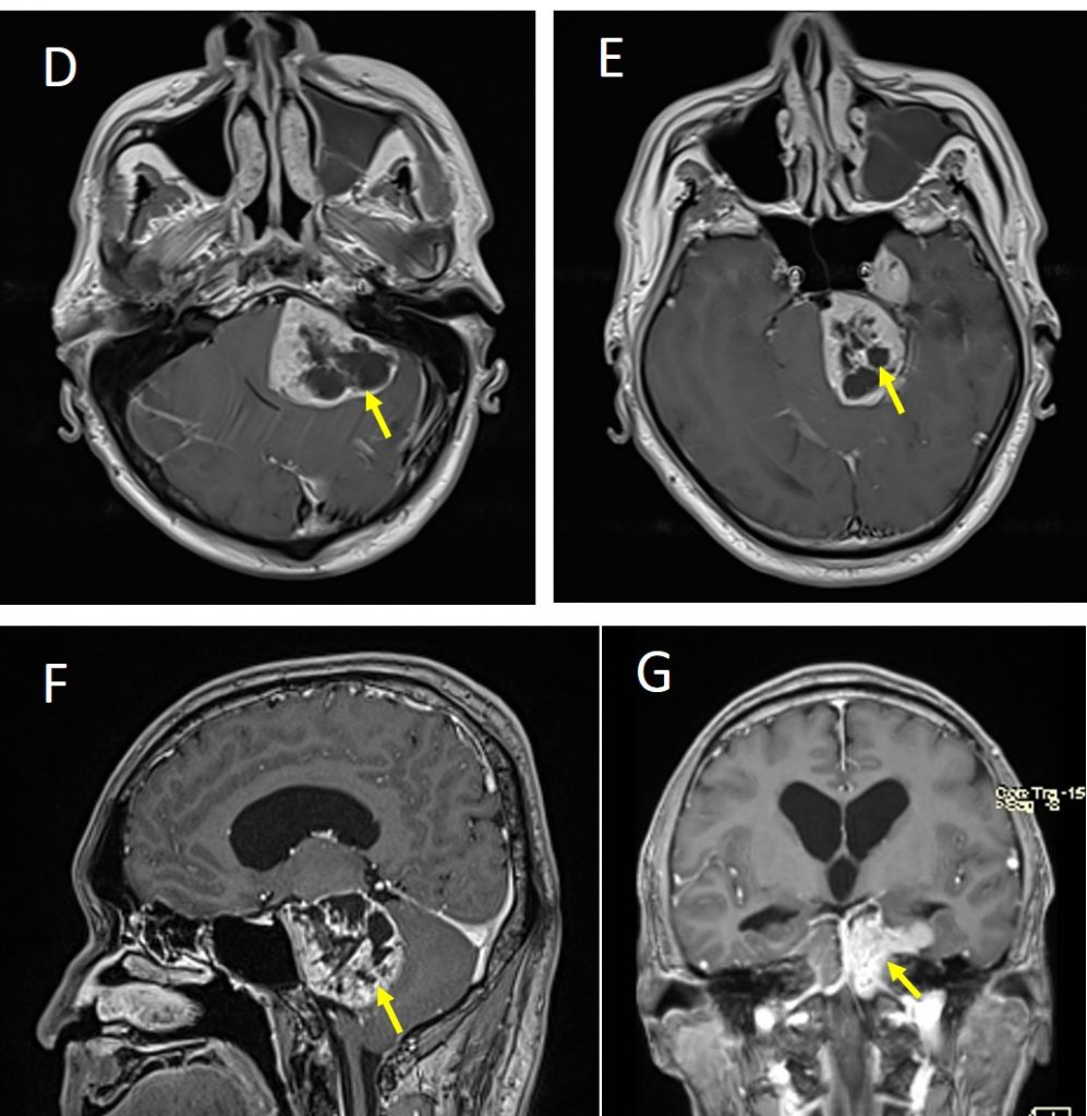 intracranial-trigeminal-schwannoma-radiology-cases