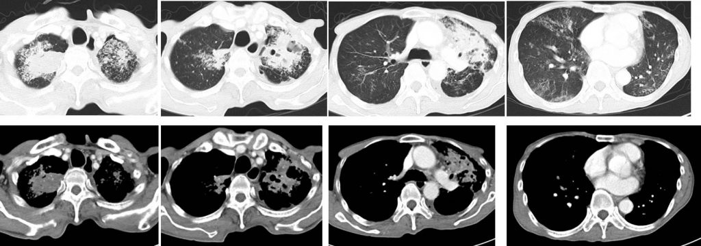 Pulmonary Tuberculosis – Radiology Cases