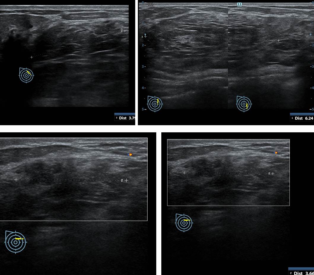 Breast fibroadenolipoma Radiology Cases