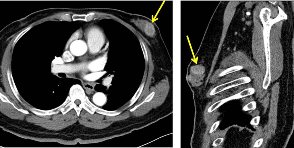Male breast carcinoma Radiology Cases