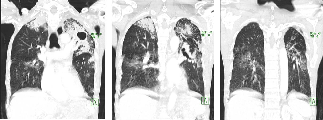 Pulmonary Tuberculosis Radiology Cases