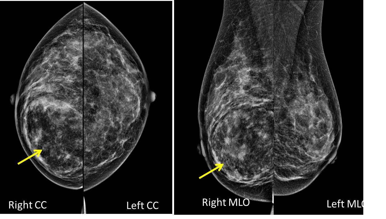 Breast Fibroadenolipoma Radiology Cases