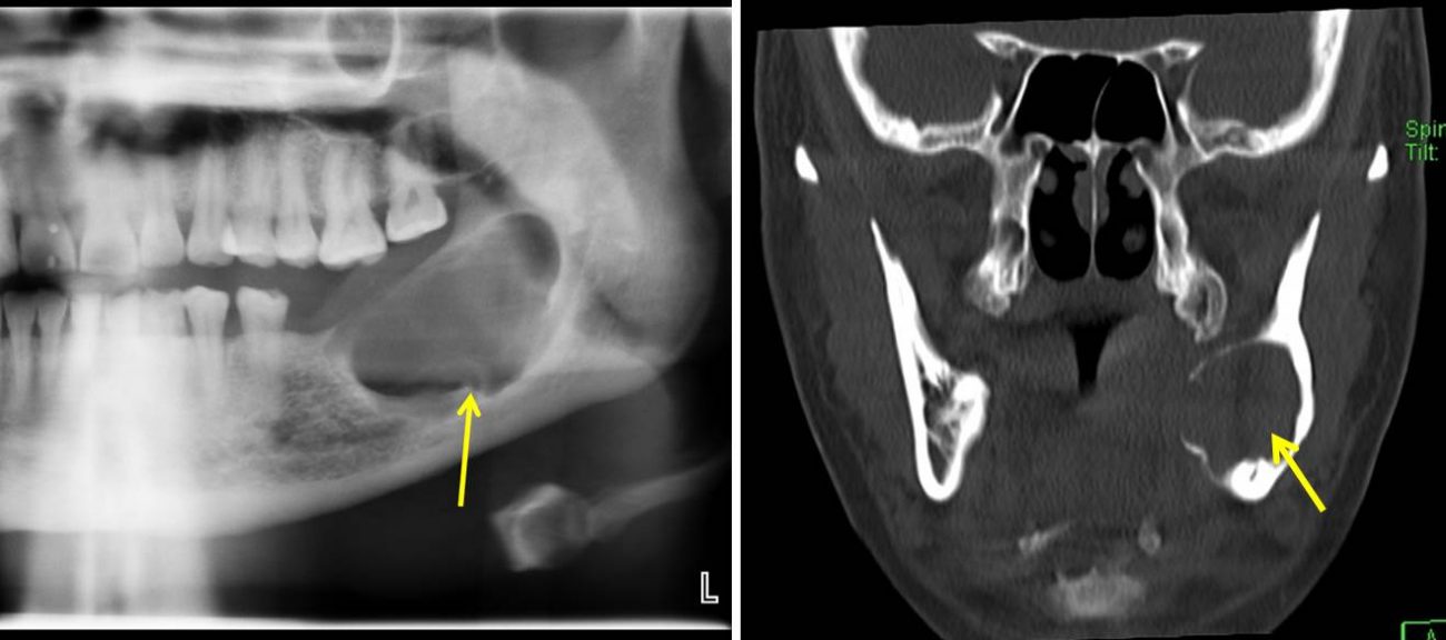 Ameloblastoma Radiology Cases