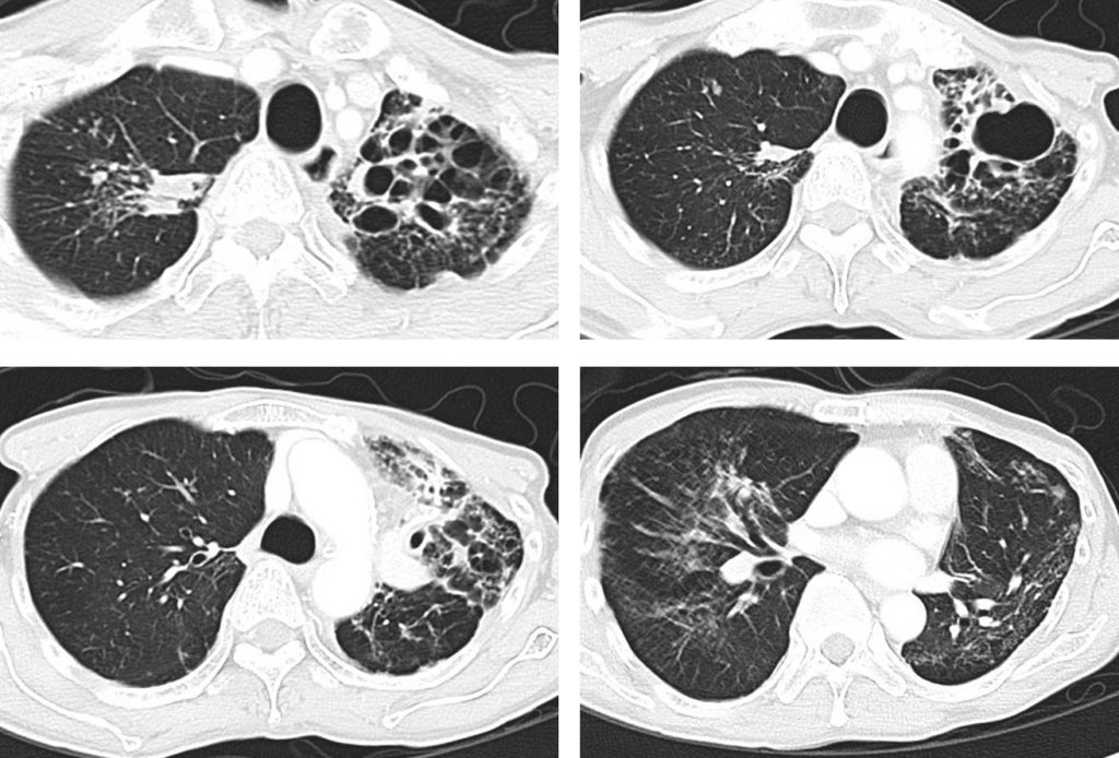 Pulmonary Tuberculosis Radiology Cases