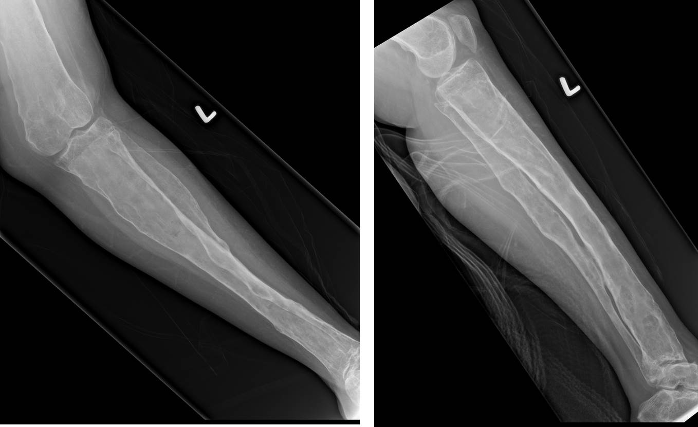 Polyostotic fibrous dysplasia Radiology Cases